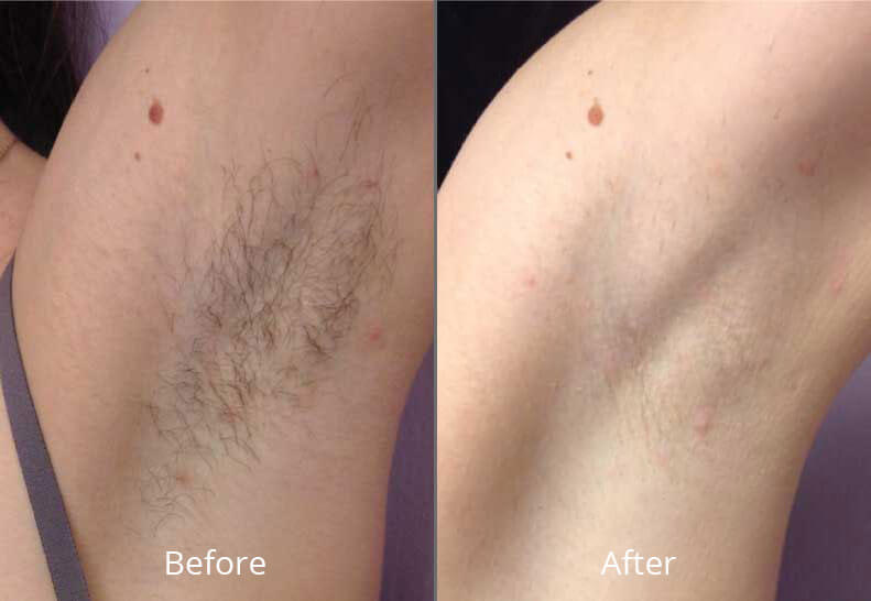 Laser Pubic Hair Removal Before And After Pictures