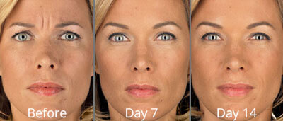 Botox before and afters at Chesapeake Vein Center and Medspa in Virginia
