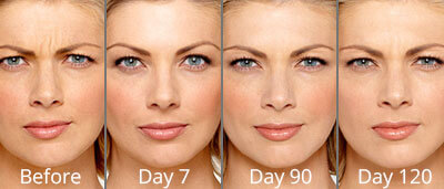  Botox before and after photos at Chesapeake Vein Center and Medspa in Virginia