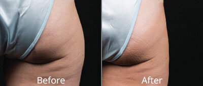 Coolsculpting Before and After Photos at Chesapeake Vein Center and Medspa in Virginia