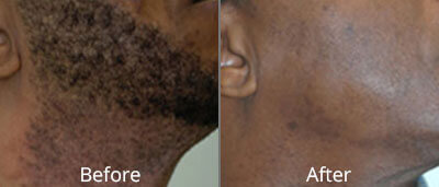 Laser Hair Removal Before and After Photos at Chesapeake Vein Center and Medspa in Virginia