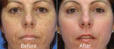 MicroLaserPeel Before and After Photos at Chesapeake Vein Center and Medspa in Virginia