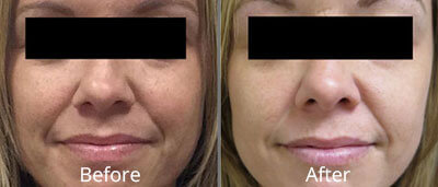 MicroLaserPeel Before and After Photos at Chesapeake Vein Center and Medspa in Virginia