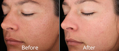 Chemical Peel before and afters at Chesapeake Vein Center and Medspa in Virginia
