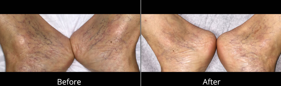 Spider Vein Removal Before and After Pictures