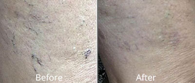 Spider Vein Treatment Before and After Photos at Chesapeake Vein Center and Medspa in Virginia