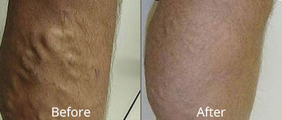 Varicose Vein Treatment Before and After Photos at Chesapeake Vein Center and Medspa in Virginia