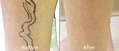 Varicose Vein Treatment Before and After Photos at Chesapeake Vein Center and Medspa in Virginia