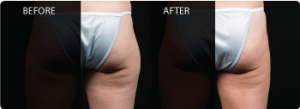 CoolSculpting Chesapeake Virginia 300x109
