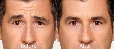  Botox before and after photos at Chesapeake Vein Center and Medspa in Virginia