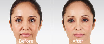 Juvéderm before and after pics at Chesapeake Vein Center and Medspa in Virginia