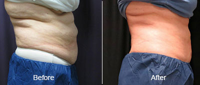Coolsculpting Before and After Photos at Chesapeake Vein Center and Medspa in Virginia