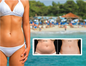  What makes CoolSculpting the best?