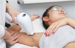 Woman receiving a laser hair removal treatment on her underarms