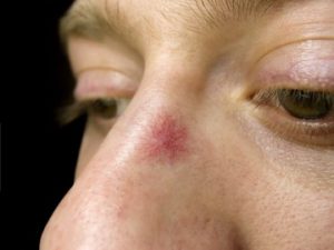Spot of redness on a person's nose