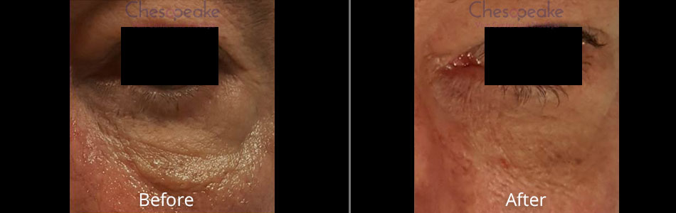 Halo Fractional Laser Before and After Photos at Chesapeake Vein Center and Medspa in Virginia