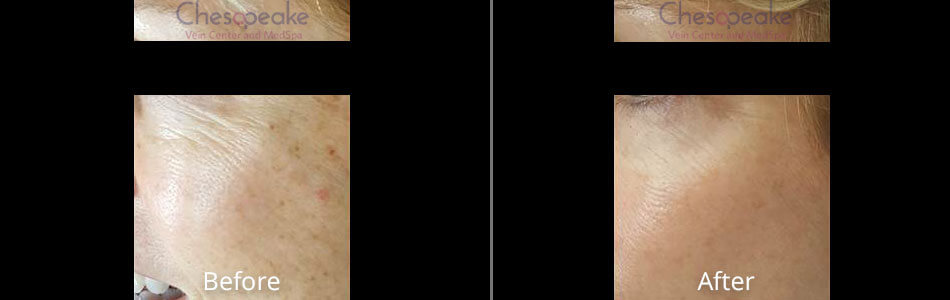 Halo Fractional Laser Before and After Photos at Chesapeake Vein Center and Medspa in Virginia