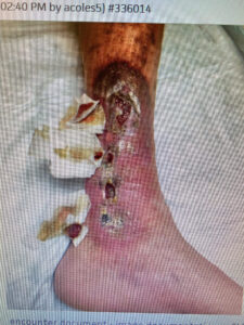 venous reflux leg ulcers before