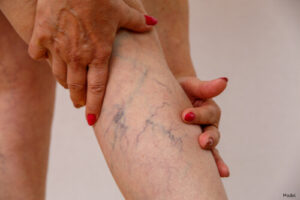 person having leg pain from veins