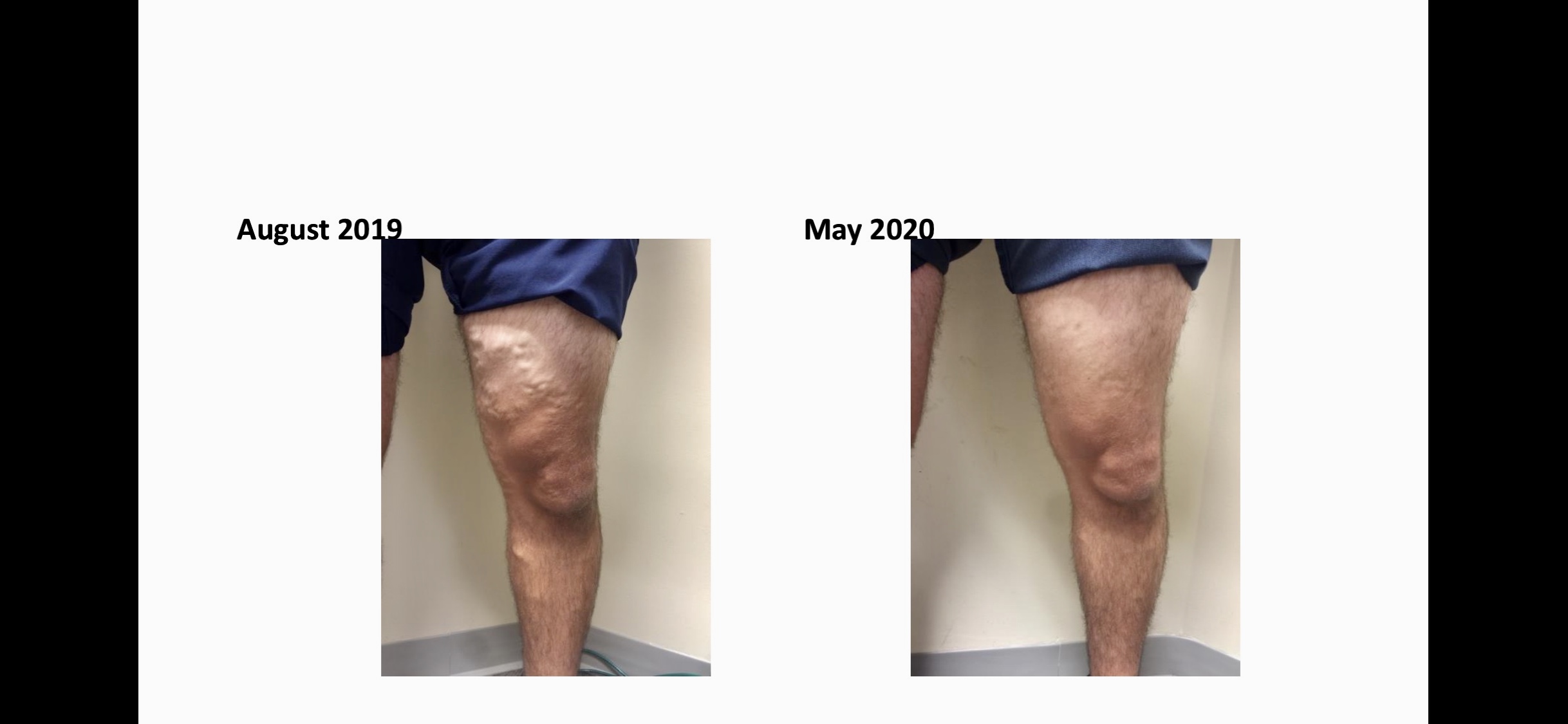 This patient was seen in 2019 with large varicosities. They underwent radiofrequency ablation in late 2019. Radiofrequency ablation is a minimally-invasive option that heats and damages the inner walls of your varicose veins, causing scar tissue to form in the vein. This closes off the vein and results in blood flow redirecting to healthy veins, allowing the body to gradually absorb the varicose vein so it fades from view. The After photos were taken six weeks after treatment on saphenous veins and varicose veins. 
    The patient is very happy! 
    