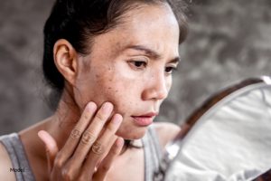 Woman with sun damaged skin looking in the mirror touching her face