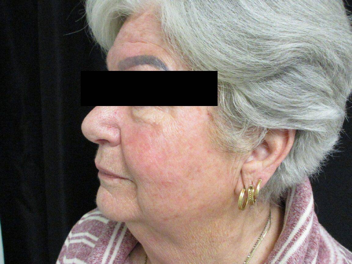 After Image: BBL and HALO - left-front-oblique