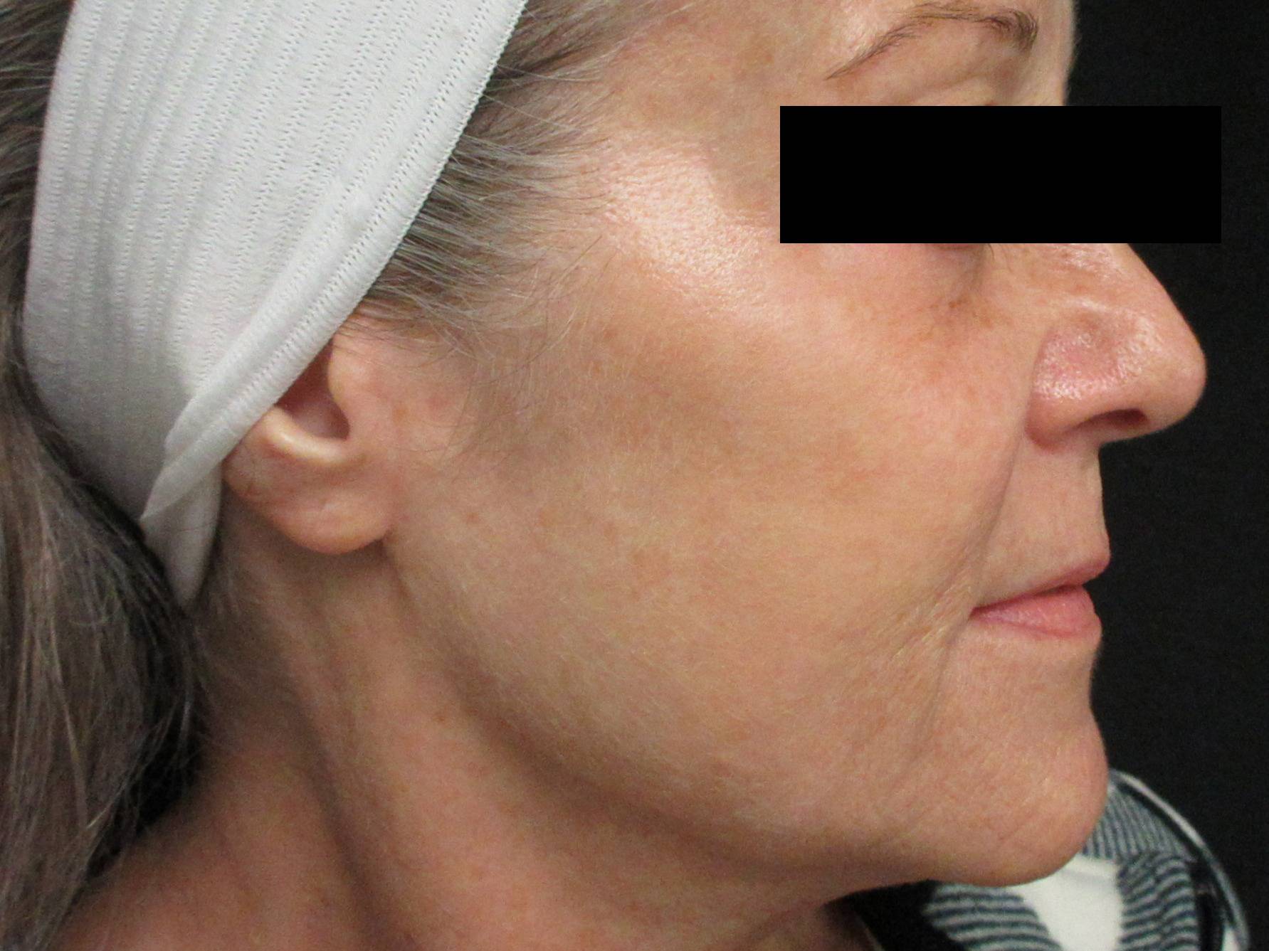 After Image: BBL - right-side