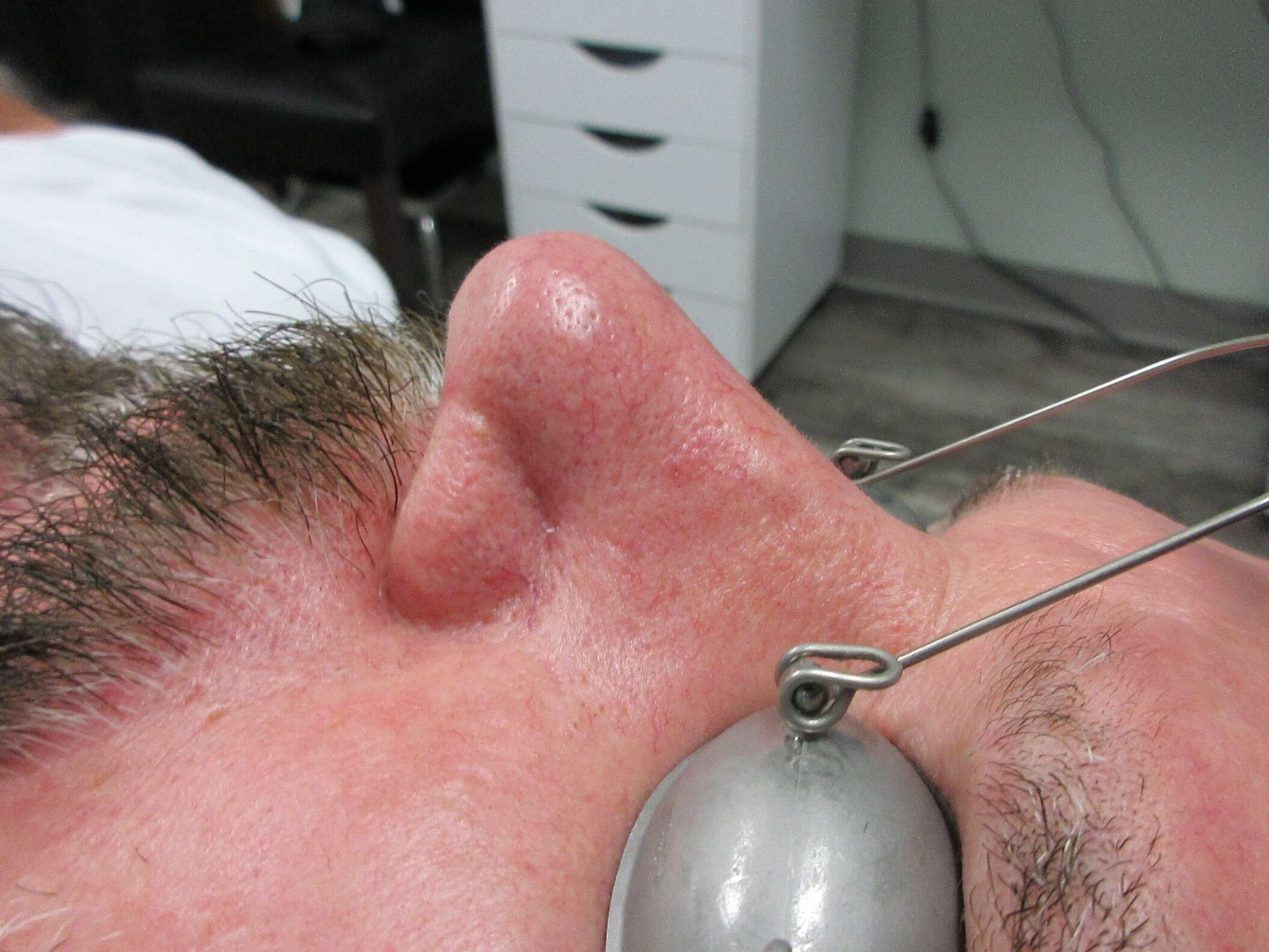 After Image: Laser Spider Vein Series - front