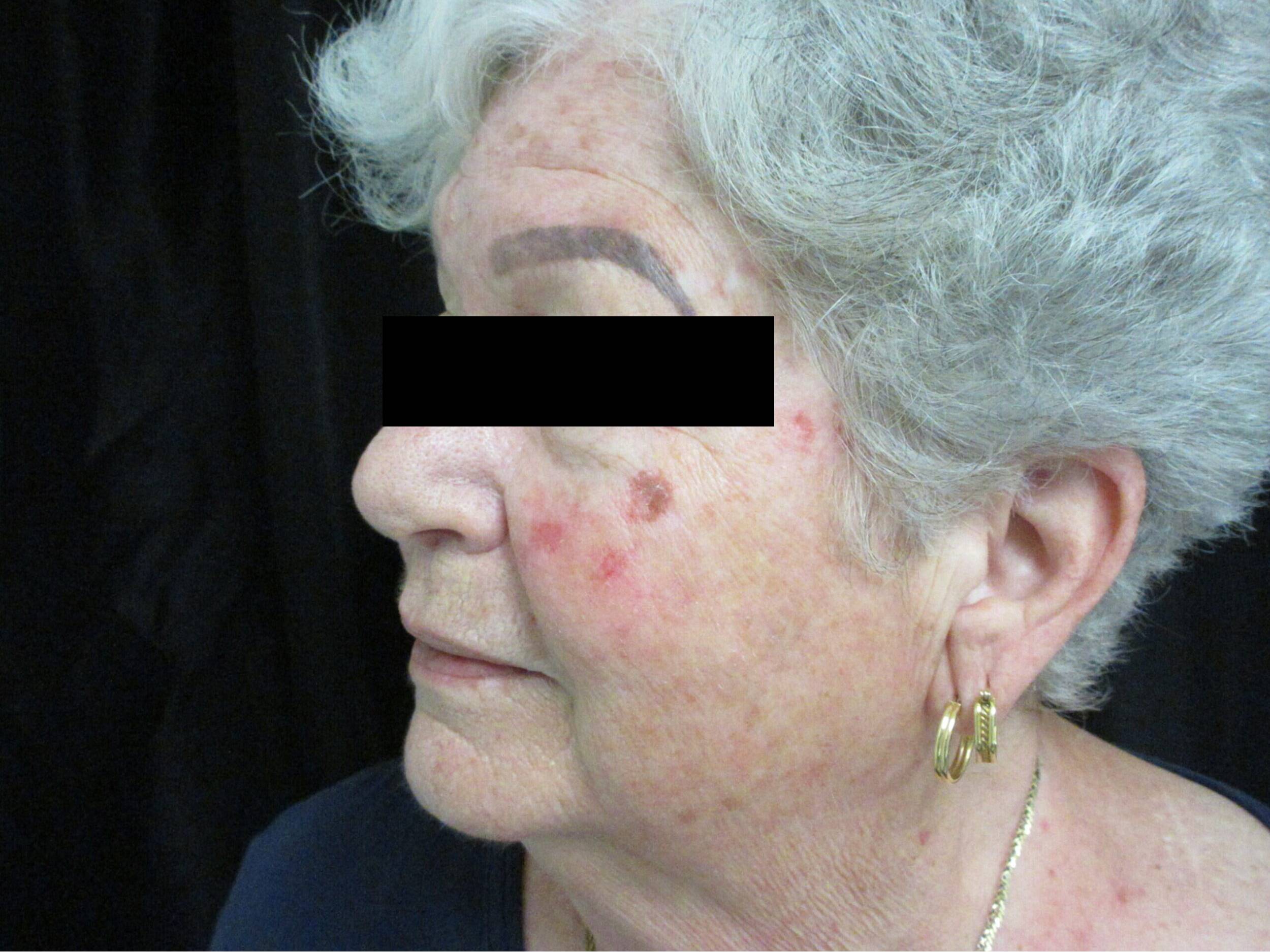 Before Image: BBL and HALO - left-front-oblique