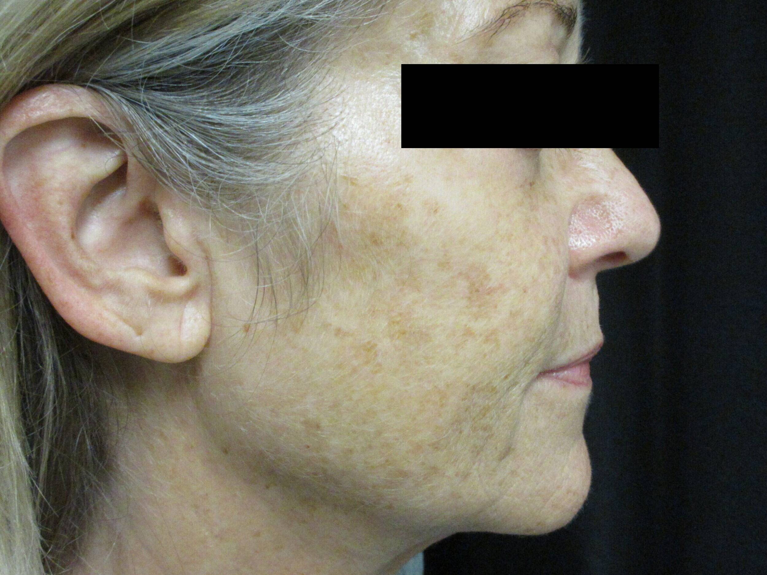 Before Image: BBL - right-side