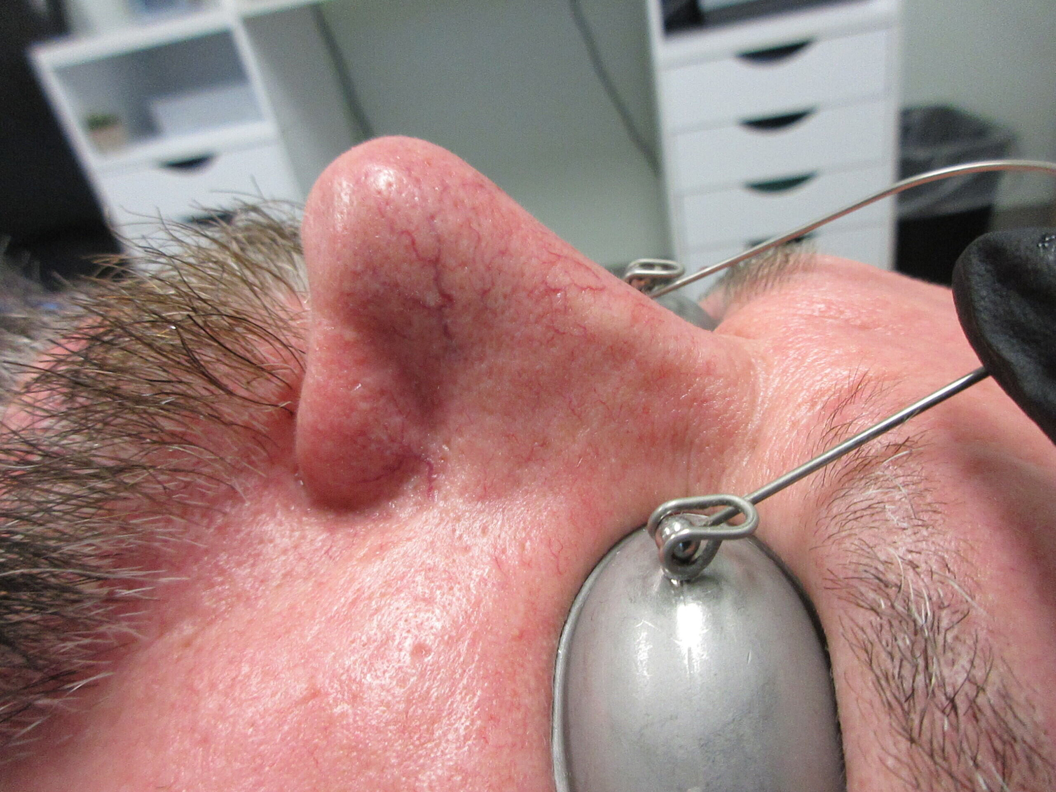 Before Image: Laser Spider Vein Series - front