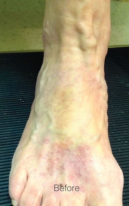 Before Image: Varicose Veins - front