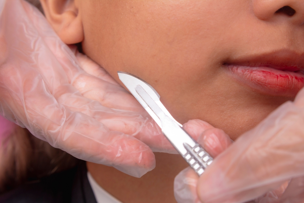 Close-up of a dermaplaning procedure gently exfoliating the skin by closely shaving the surface, removing dead skin cells and peach fuzz for a smoother, radiant complexion.