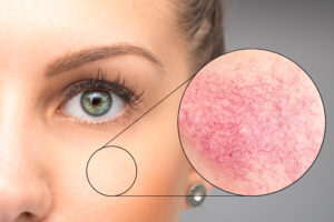 Magnified view of cheek showing redness and flushing on a woman’s skin, highlighting common skin concerns treated with photofacials