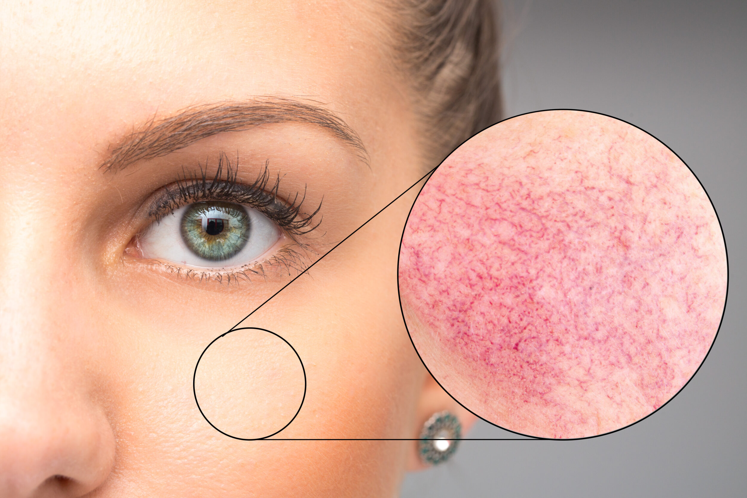 Magnified view of cheek showing redness and flushing on a woman’s skin, highlighting common skin concerns treated with photofacials