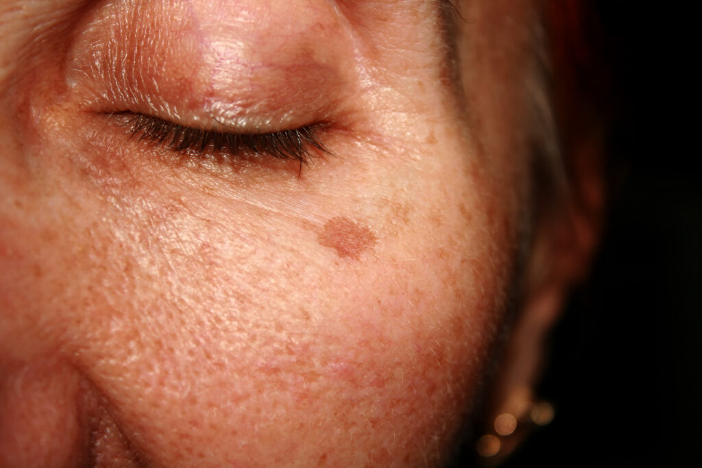 Close-up of brown spots and pigmentation under a woman’s eye, suitable for BBL photo treatment to improve skin tone