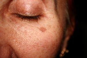 Close-up of brown spots and pigmentation under a woman’s eye, suitable for BBL photo treatment to improve skin tone