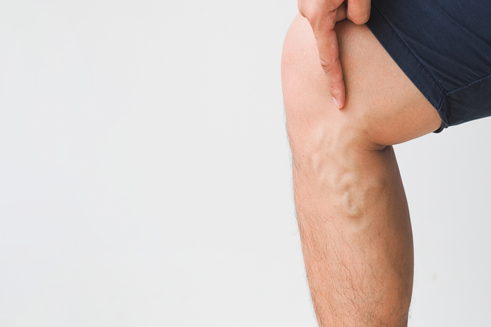 A man's leg is shown against a white background with visible varicose veins, highlighting the need for vascular evaluation and vein treatment options