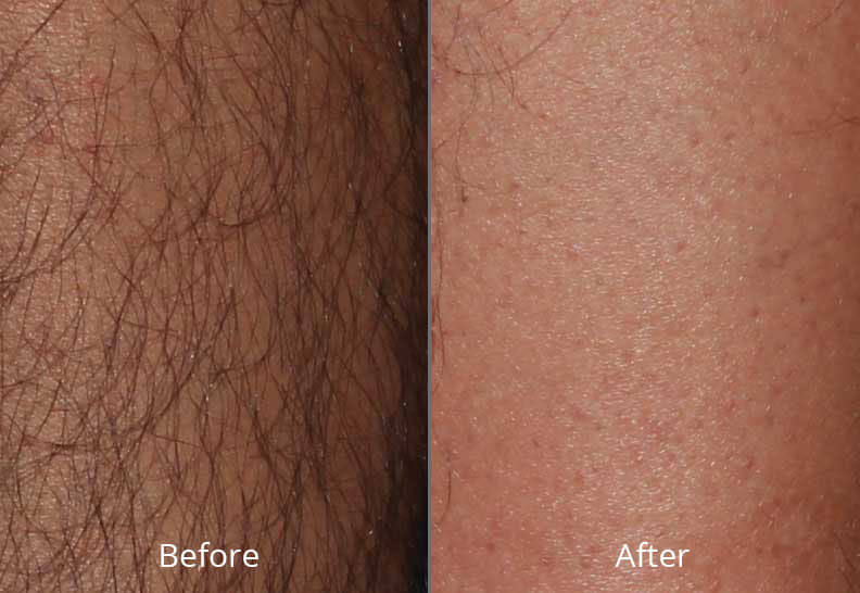 Before & After Hair Reduction Norfolk VA