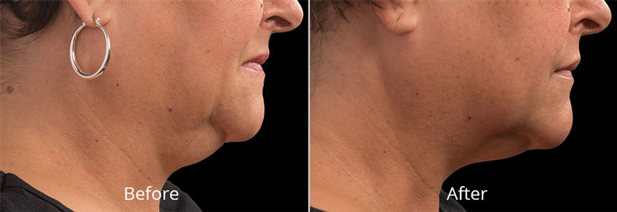 coolsculpting double chin before after Norfolk