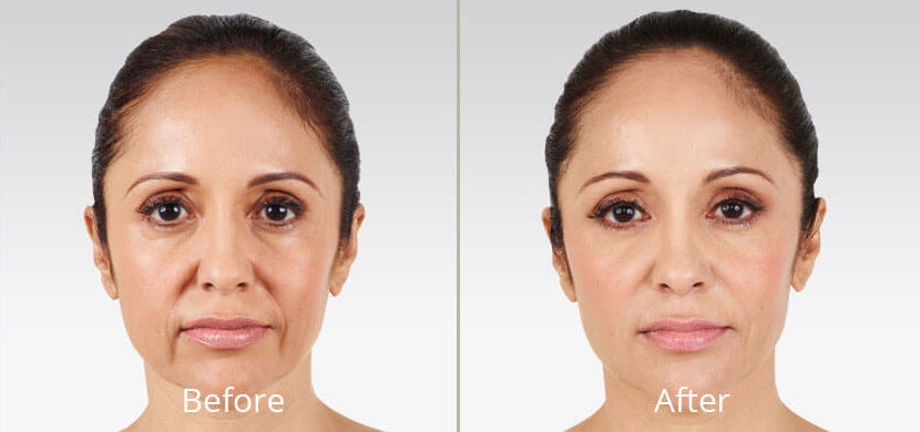 Before & After Juvéderm Filler Norfolk