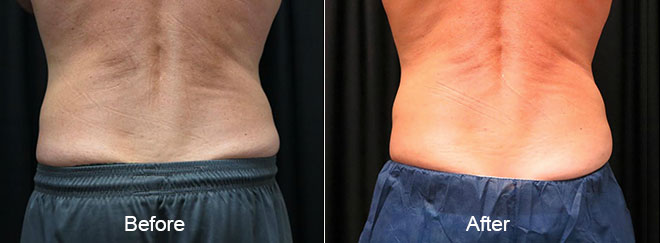 Before & After CoolSculpting Treatment Norfolk VA