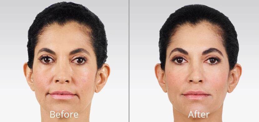 Before & After Juvéderm Filler Chesapeake