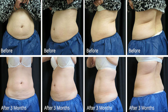 Before After coolsculpting Treatment VA