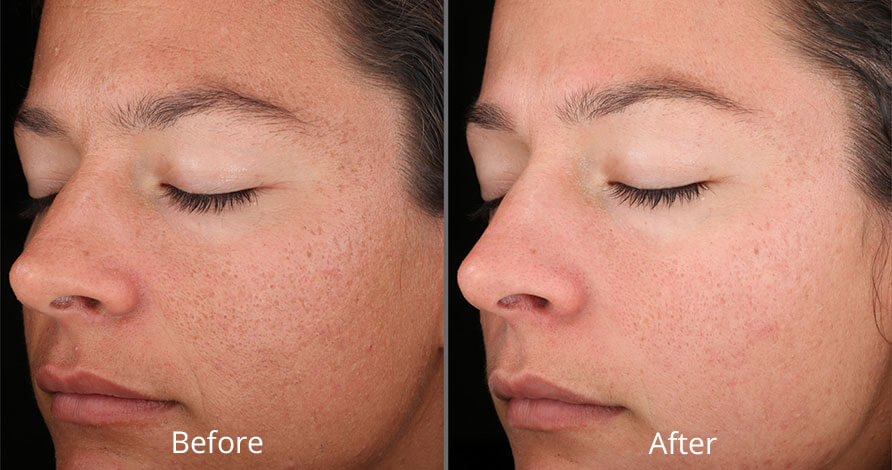 Before & After Chemical Peels Treatment Norfolk VA