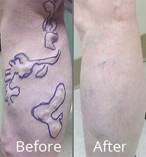 Before & After Vein Stripping Norfolk