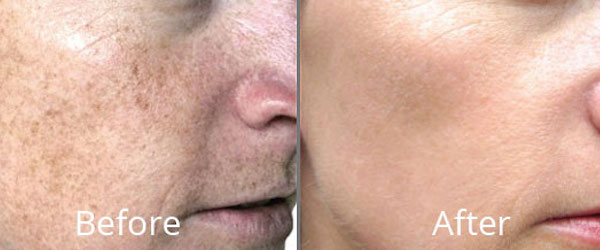 Before & After Photofacials Norfolk VA