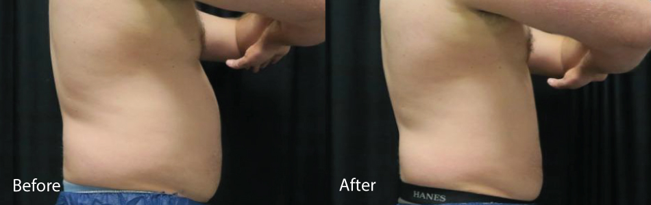 Before & After coolsculpting Norfolk