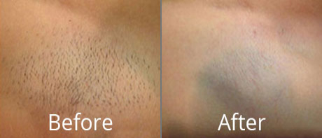 Before & After Hair Reduction Norfolk