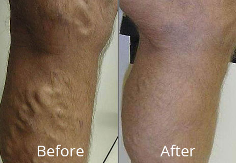 Before & After Varicose Vein Treatment Chesapeake VA